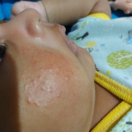 bruntusan bayi 1 bulan