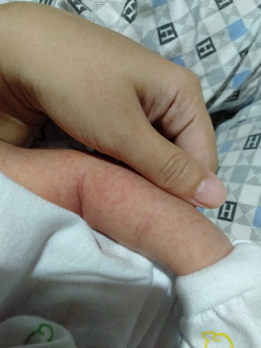 Rashes or not?