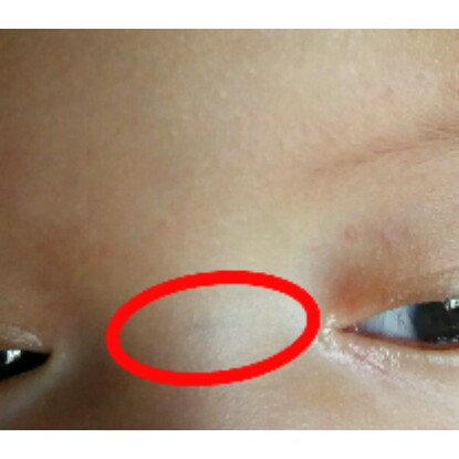 seperti urat di hidung bagian atas
