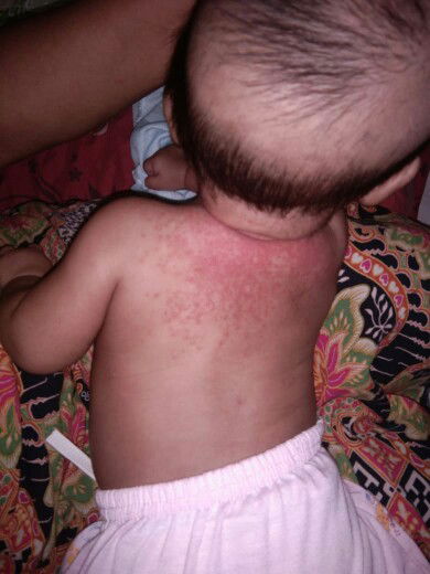 biang keringat / bintik" merah / ruam