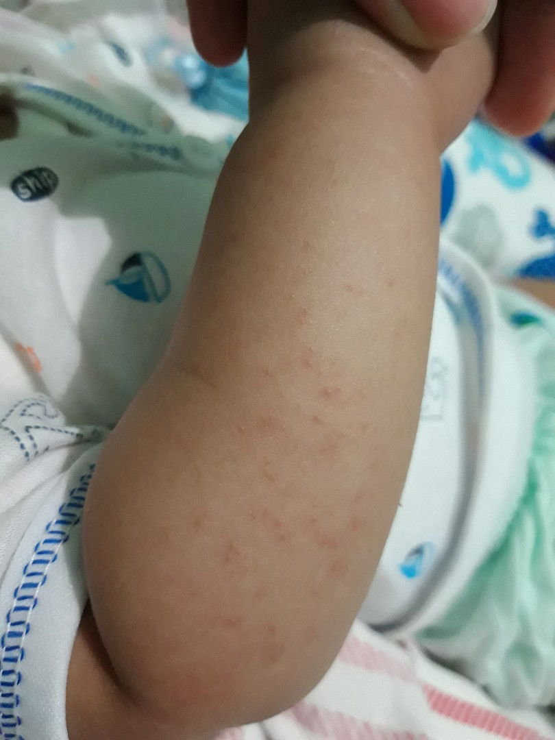 merah2 di tangan baby