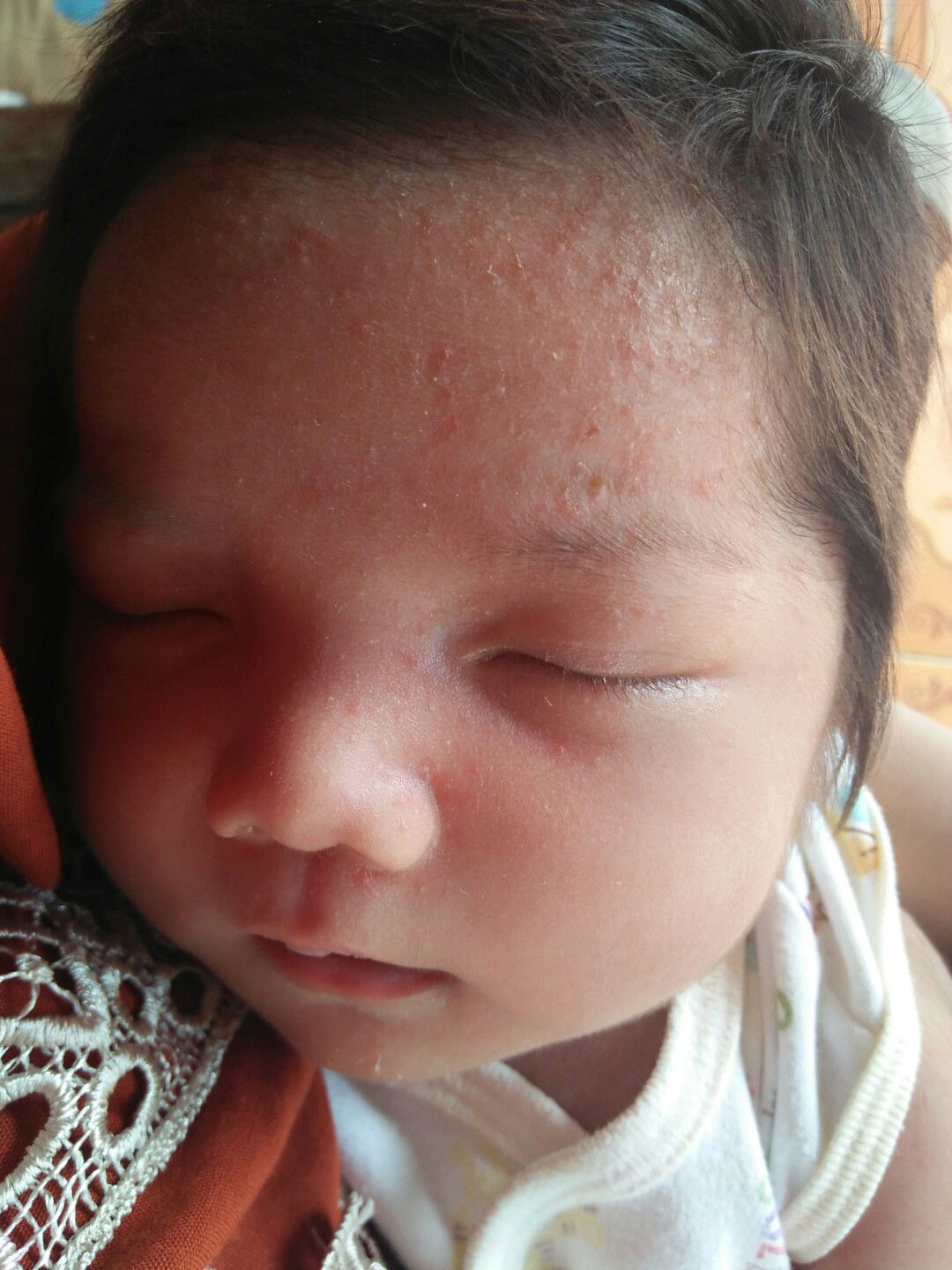 merintis/bintik2 di jidat