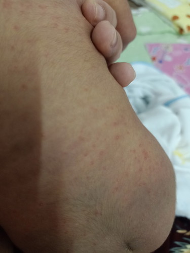 สอบถามค่ะลูกเป็นแบบนี้เรียกว่าอะไรค่ะและควรทำอย่างไร น้องอายุ12วันค่ะ
