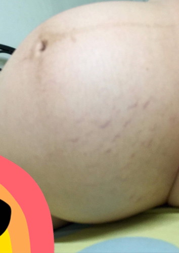 แม่ๆ บ้านใน ท้องแตก นมแตกบ้างค่ะ แตกแบบไม่รู้ตัว ขอภัยภาพไม่น่าดู