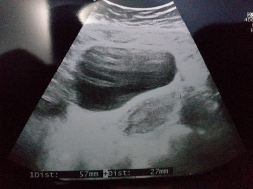 Usg 4w hasilnya begini