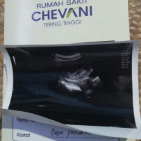 Di tespek Hcg sama bidan positif. tukang urut bilang ada. tapi usg Hamil Bo.