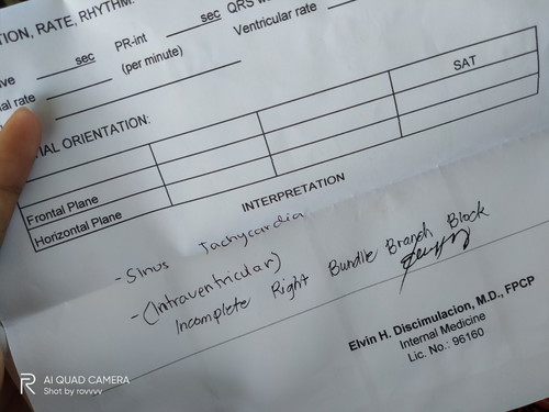 incomplete right bundle branch block