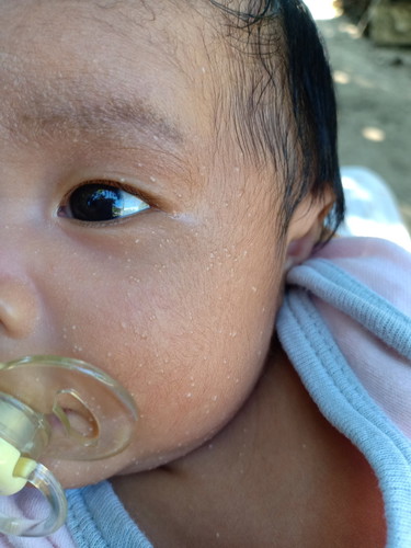May mga maliit na puti sa face niya.