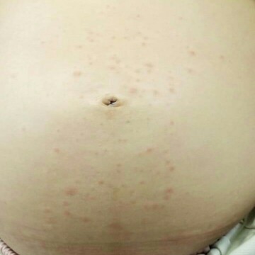 เป็นผื่นแดงๆที่หน้าท้อง