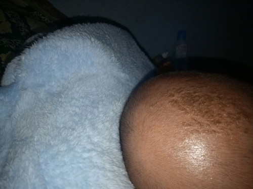 kerak di kepala bayi