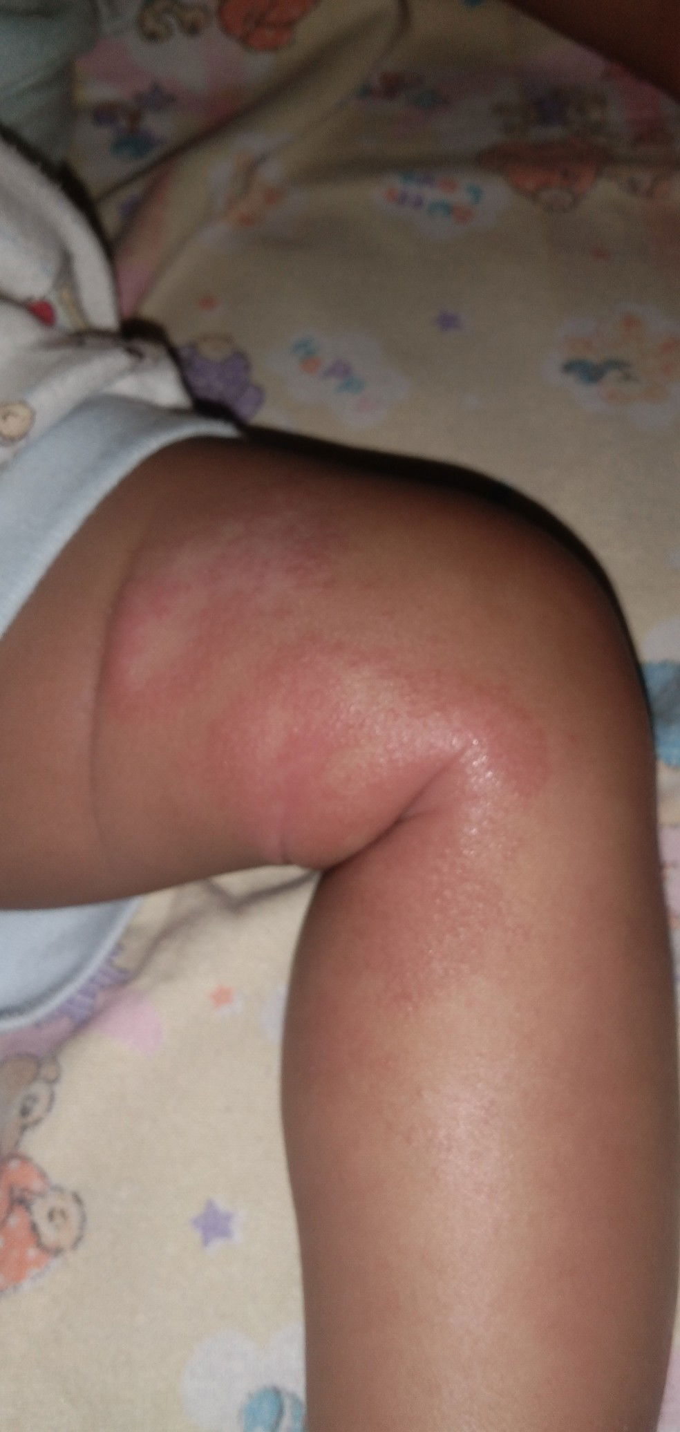 ruam bentol2  atau dermatitis atopik