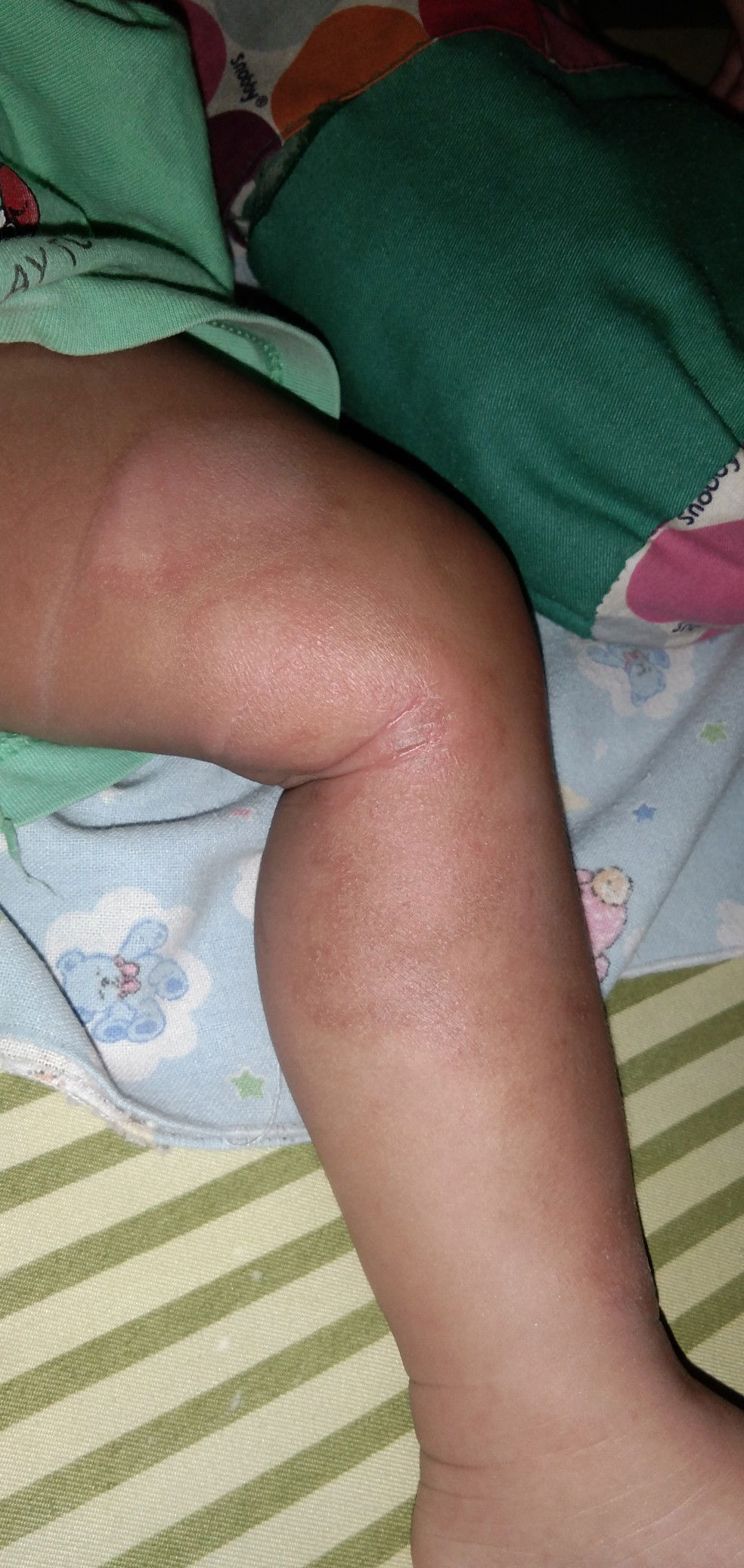 kulit bayi 5 bulan kering dan pecah2