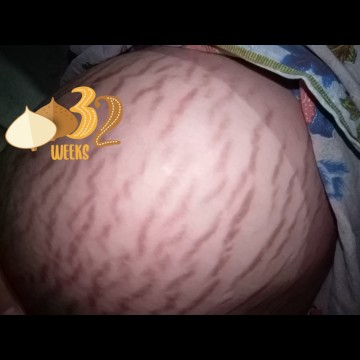 แชร์ประสบการณ์ท้องแตกลายคะ