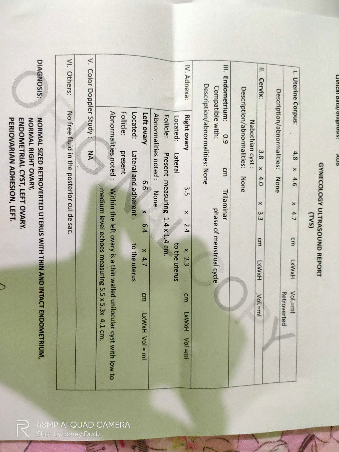 Thin Walled Unilocular Cyst