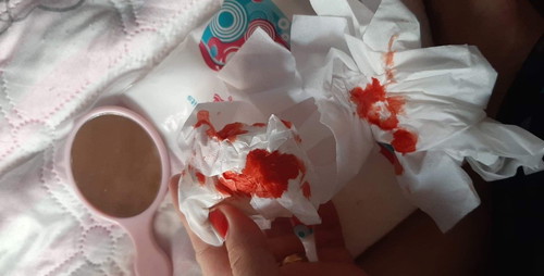 nose bleed