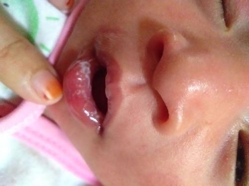 ada putih2 di mulut bayi