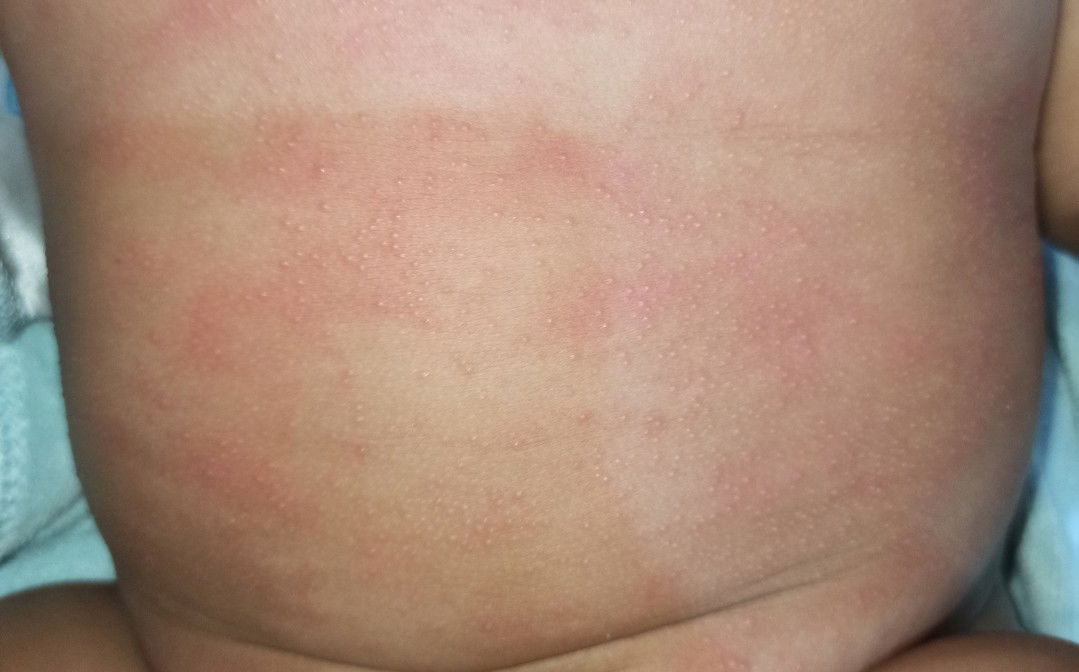 Beruntusan/bintik di kulit