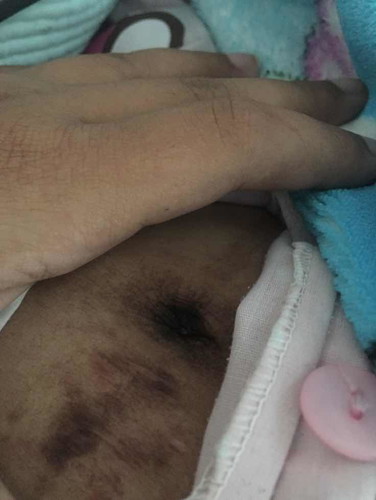 สะดือดำมาก