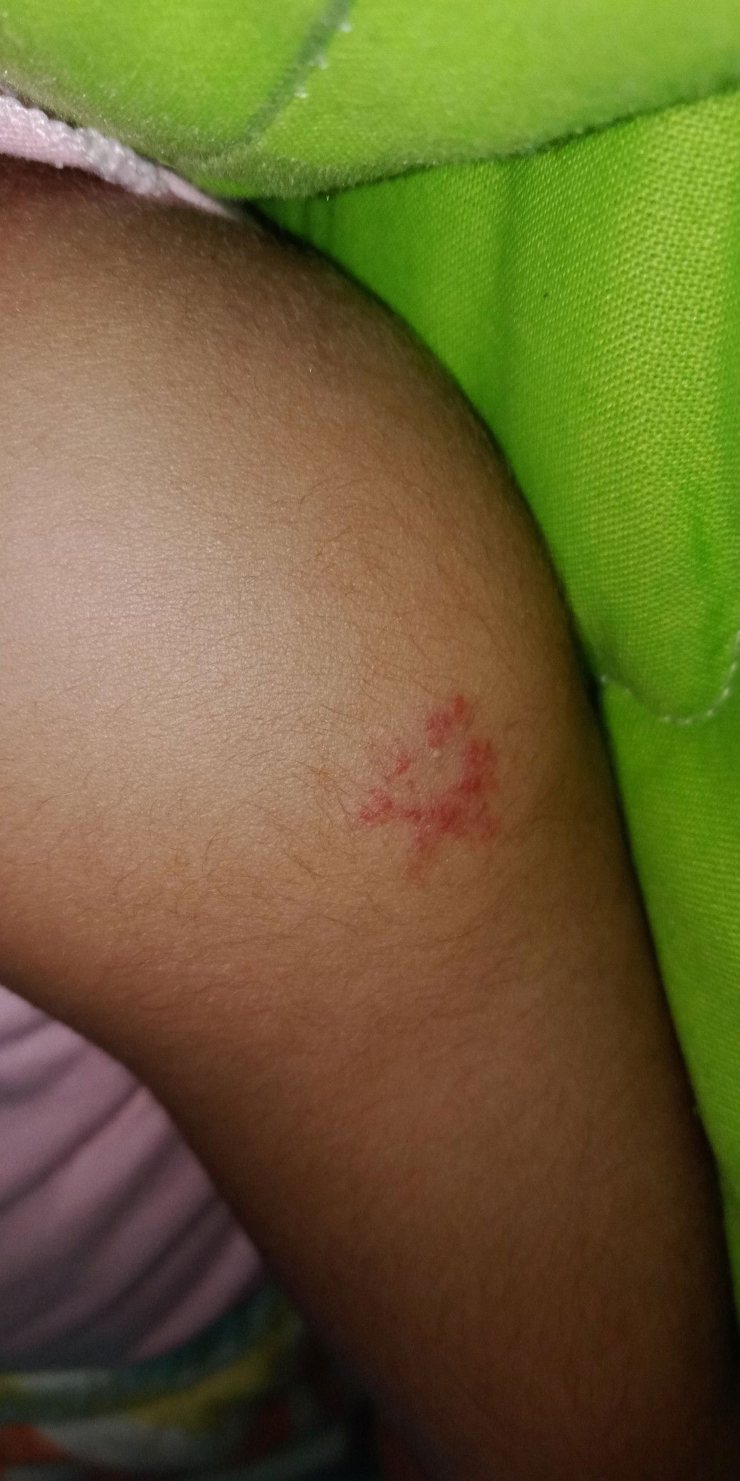 timbul kemerahan di lengan bayi 1 bulan bahaya nggak Bun?