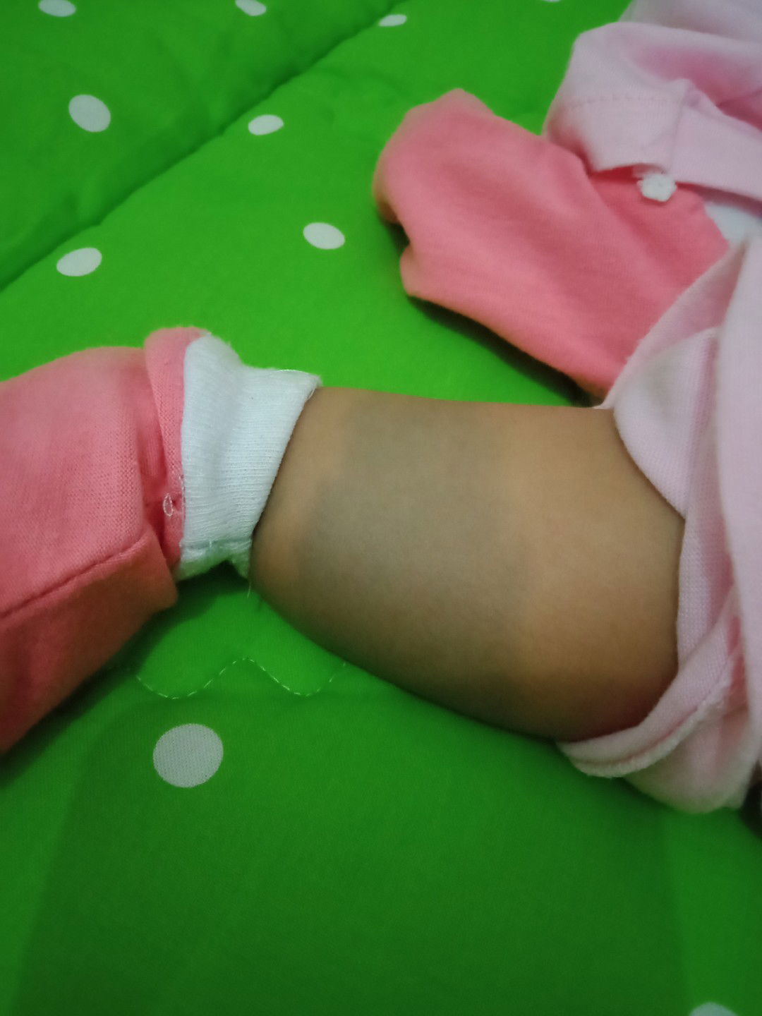 tanda lahir kebiruan bisa hilang nggak? ada yg tau bunda?