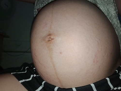 Stretchmarks