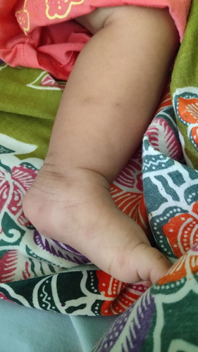 bekas hitam di tubuh