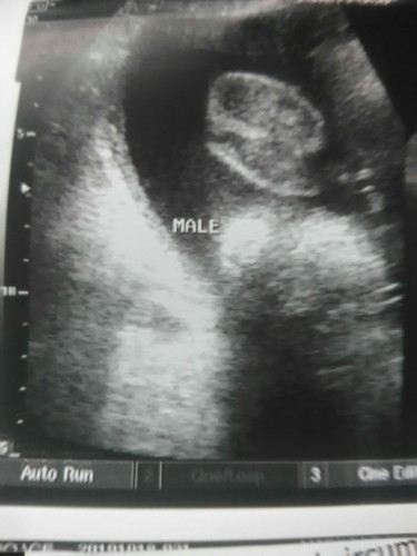 Ultrasound result