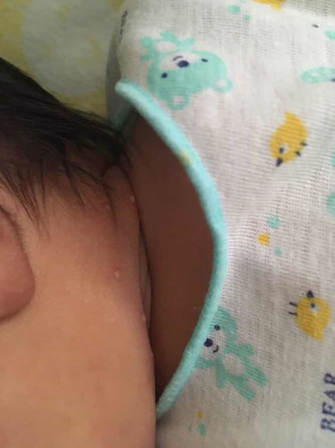 เป็นตุ่มสีขาวเหลืองที่คอ