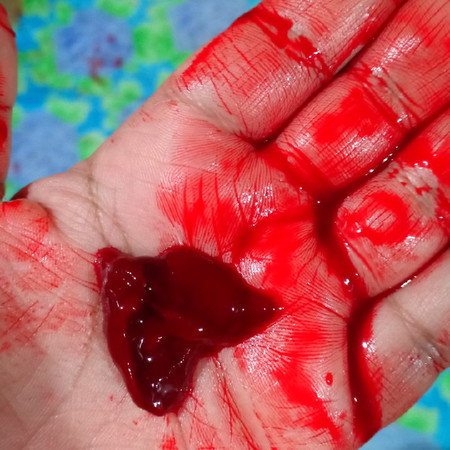 bleeding