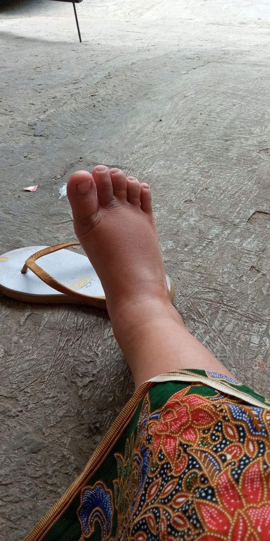 kaki bengkak ..nyeri tuoang vgina sebelah kiri .rembes air outih