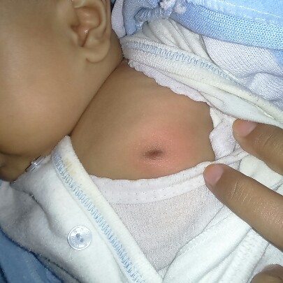 benjolan diputing susu bayi