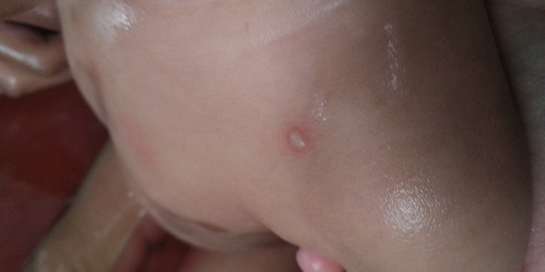 cacar air atau bukan