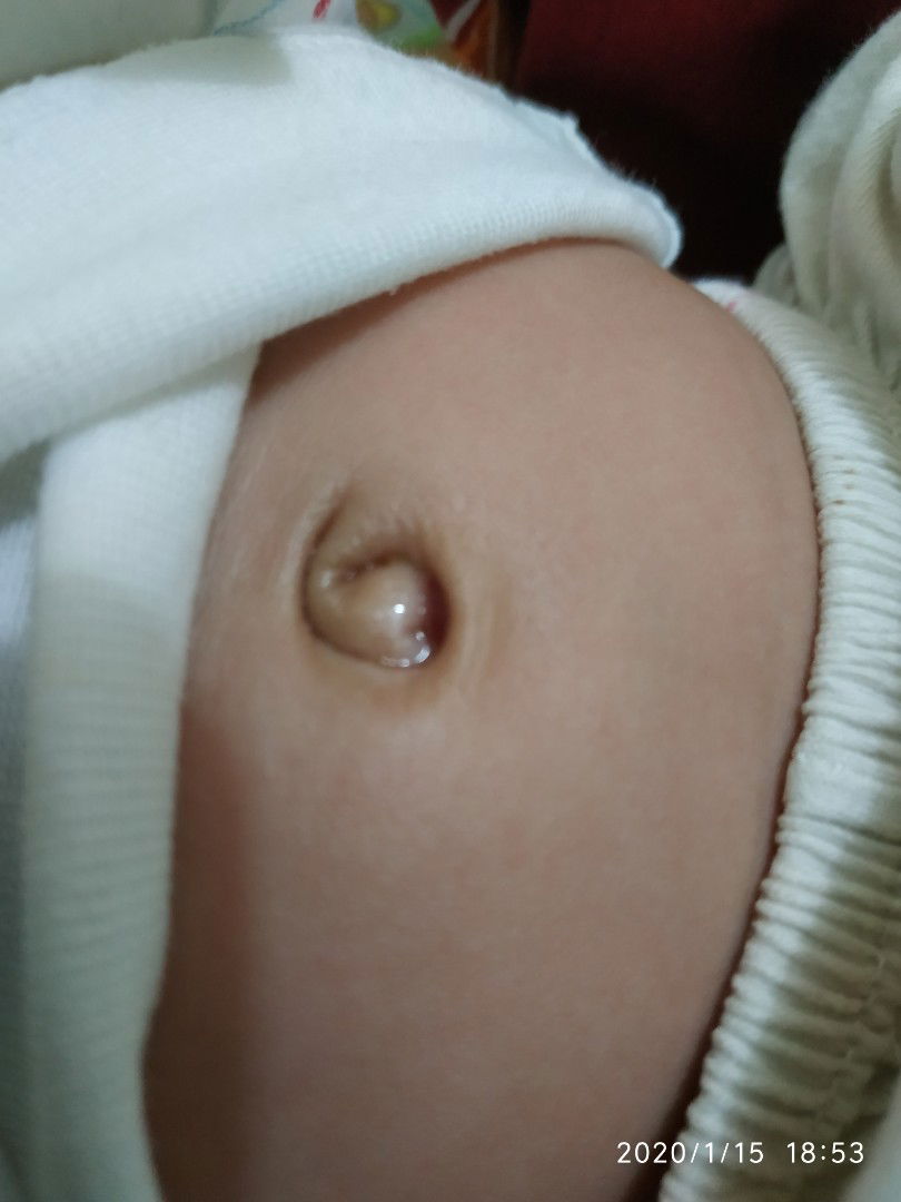 ada daging di pusar bayi