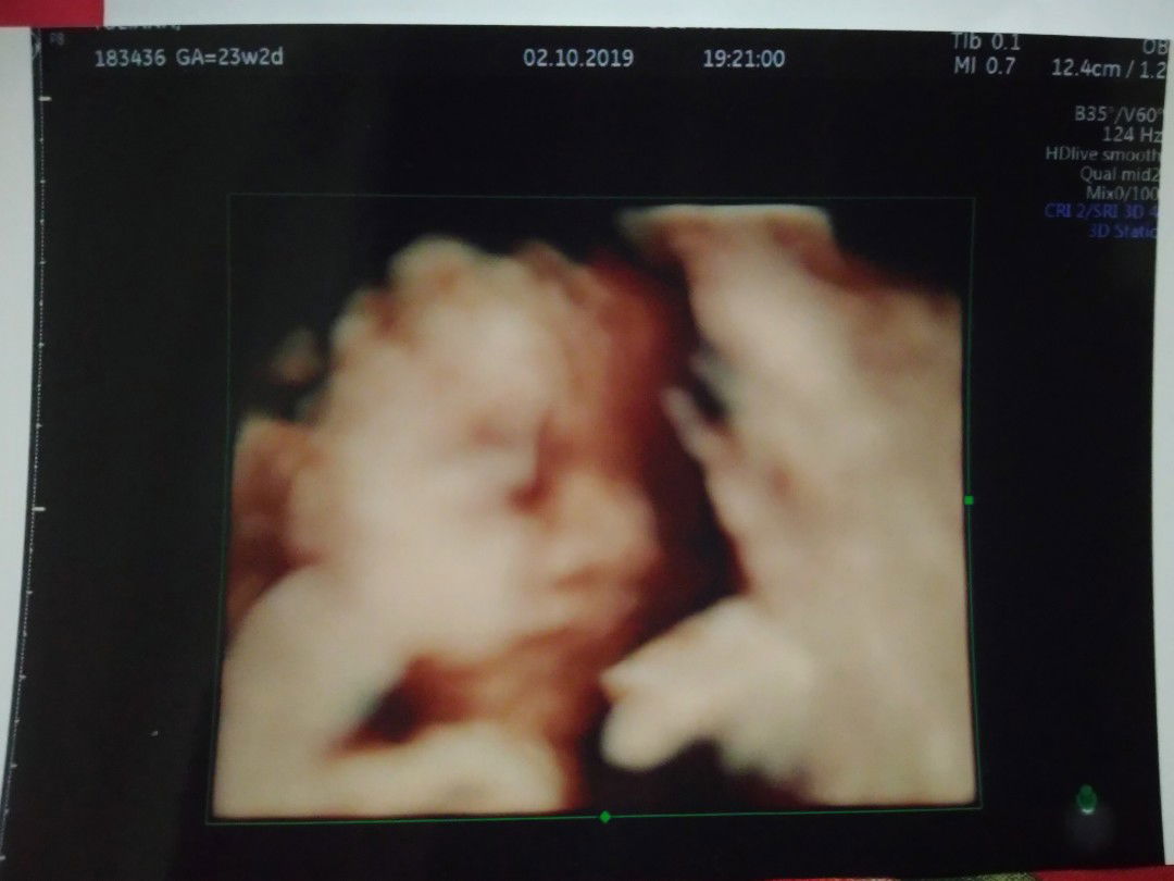 alhamdulillah baby Girl 23w :*