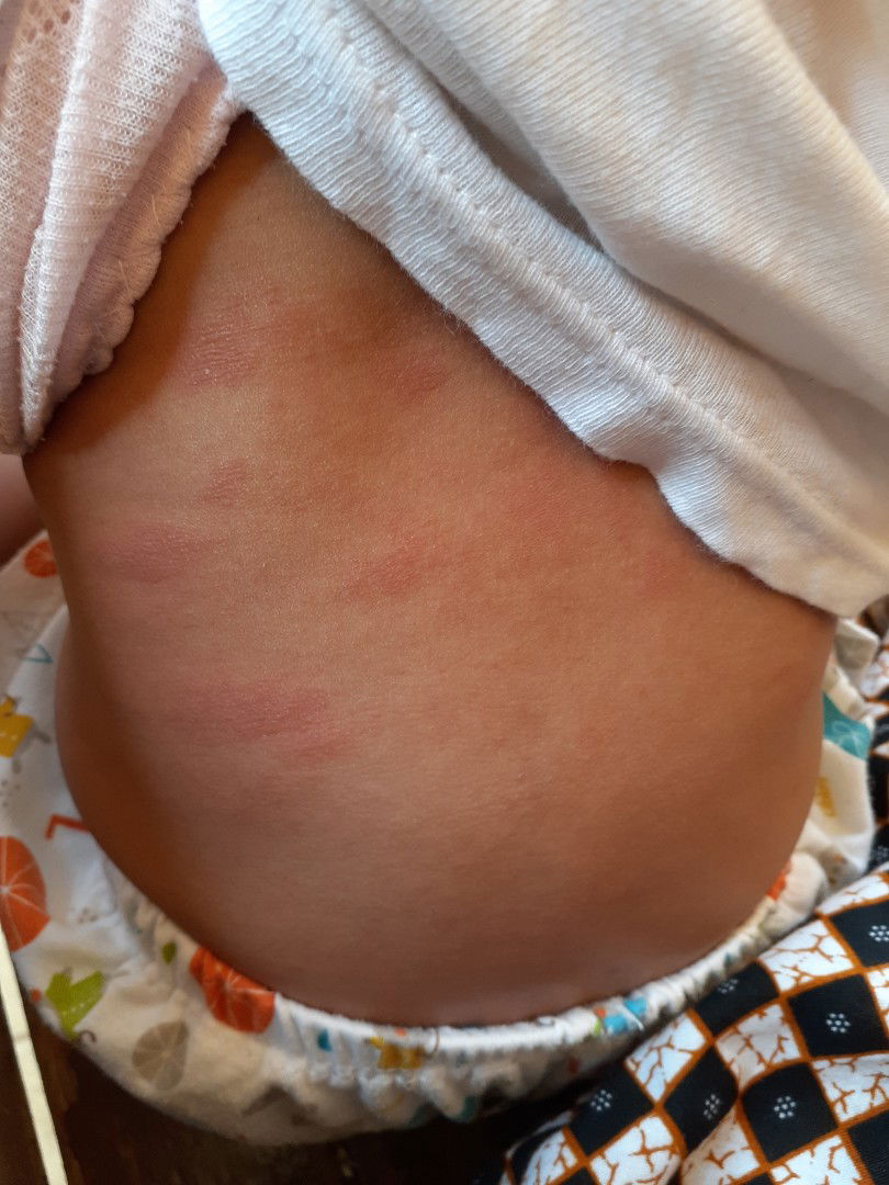 panas dan merah merah dibadan