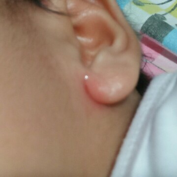 any idea sa sugat ni baby