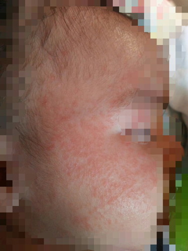 rashes