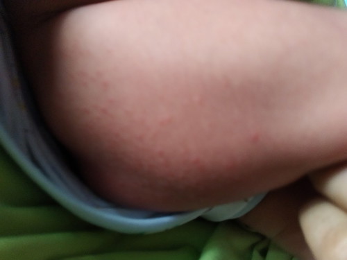 beruntusan atau biang keringat