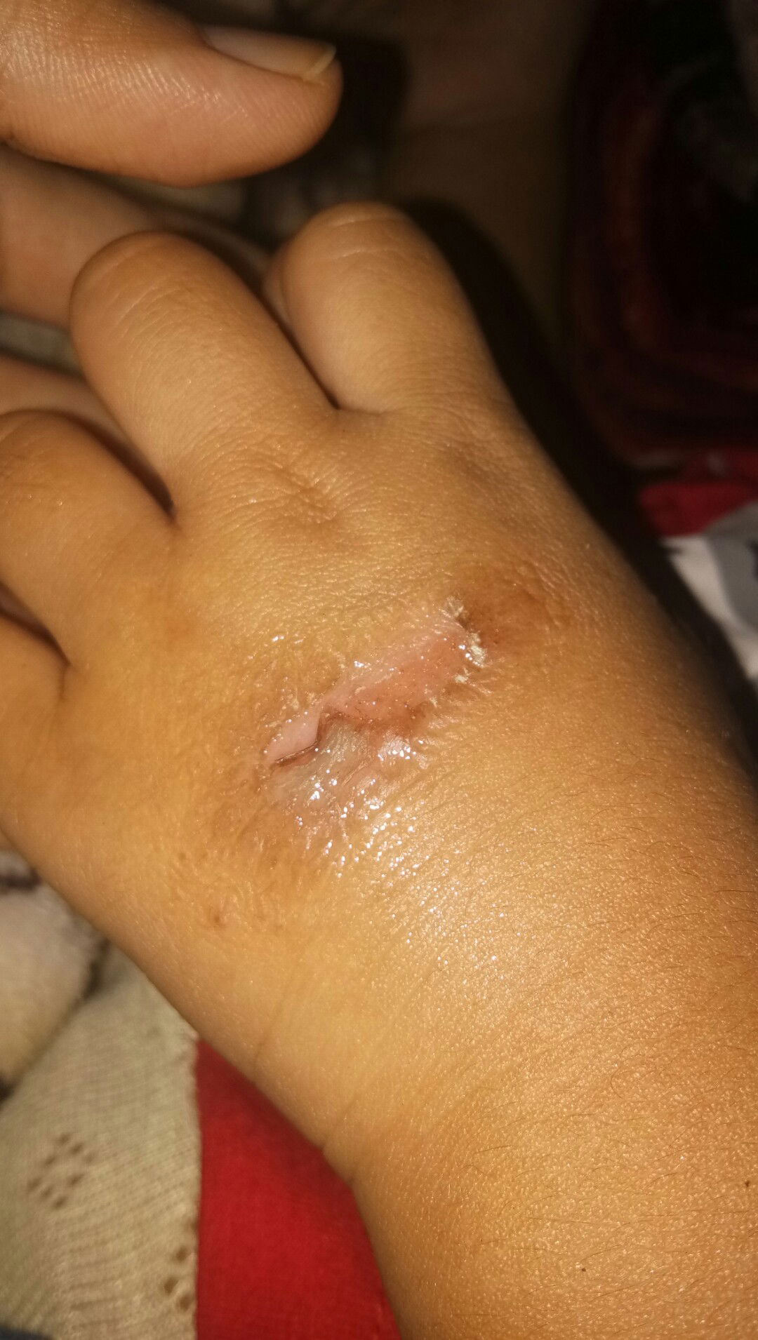 krim atau salep penghilang luka