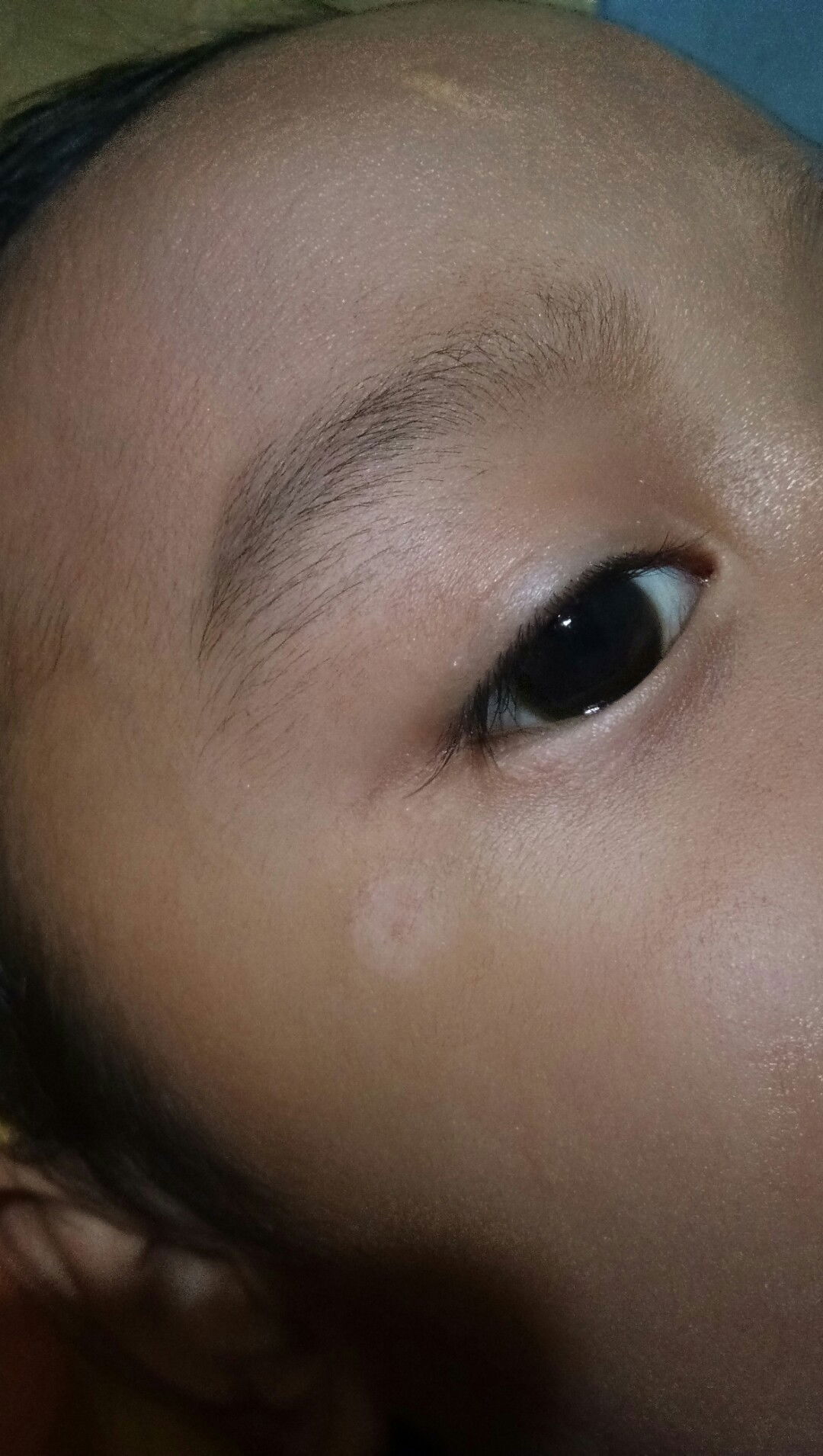 lingkaran putih pada wajah anak