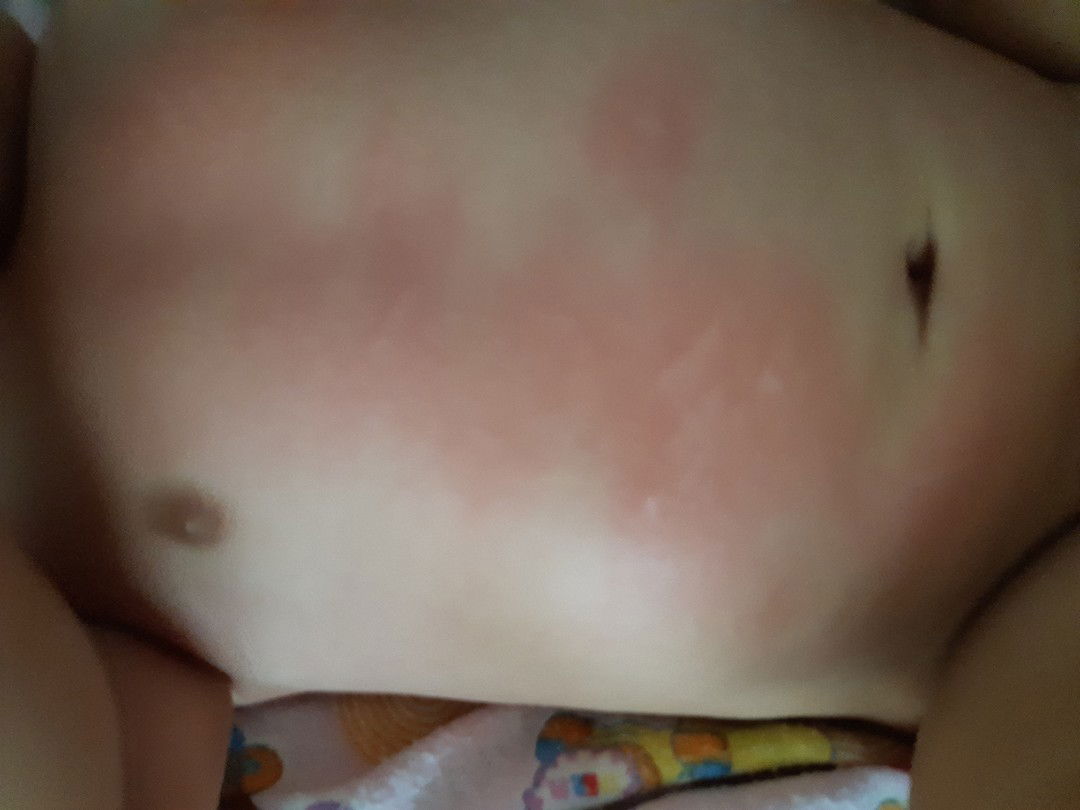 Bentol merah setelah imunisasi