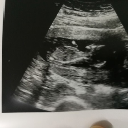 13w 4d (Acute Asthmatic Mom) - Sharing Thoughts