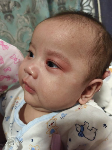 น้องเป็นแบบนี้หลังกินนม แพ้อะไรรึป่าว