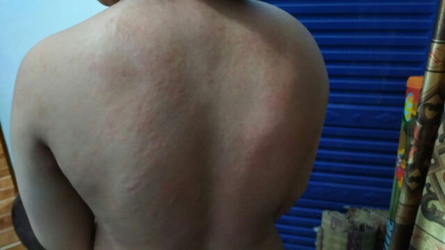 gatal ruam hamil 36 week