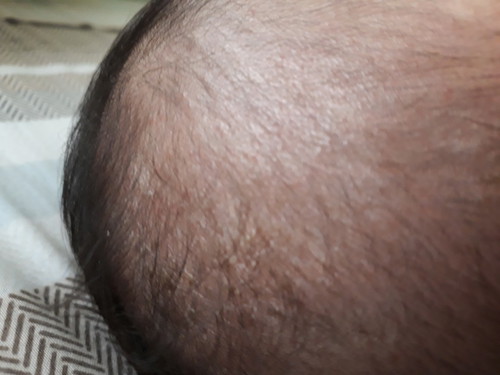 dandruff like