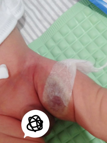 Hemangioma