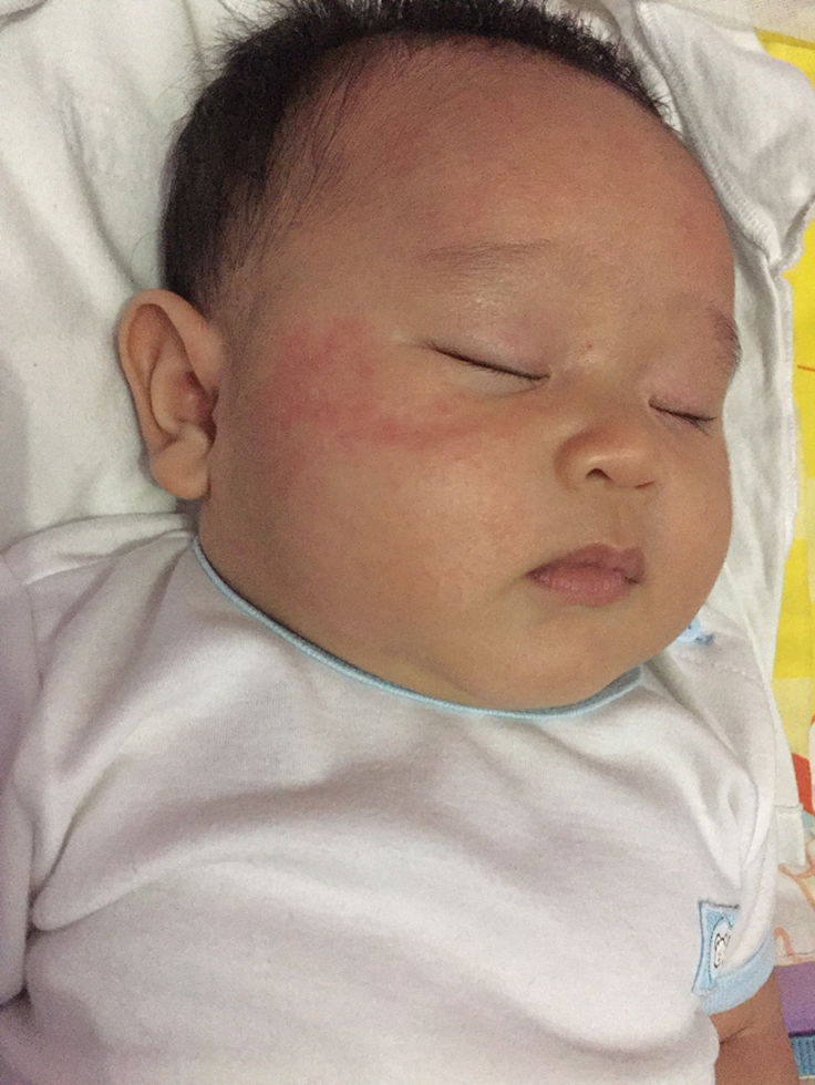 Alergi ataukah ruam ASI?