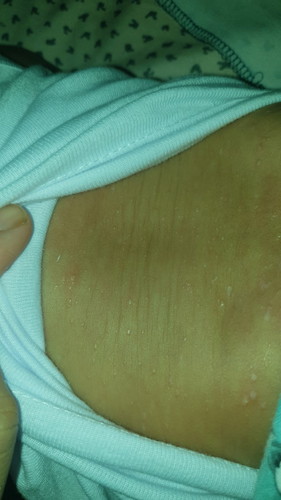 bentol di badan sampe ke muka