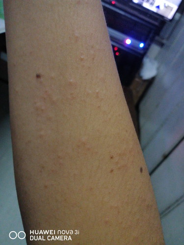 Rashes?