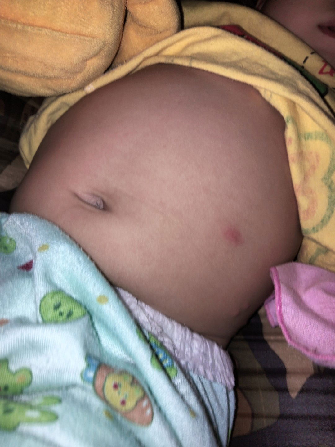 อยากสอบถามเรื่องตุ่มบนตัวเด็กทารกค่ะ